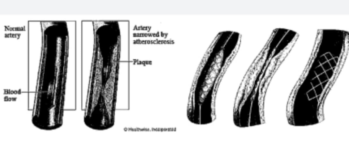 Normal
artery
Blood-
flow
Artery
narrowed by
atherosclerosis
Plaque
ⒸHestie. Incorporate